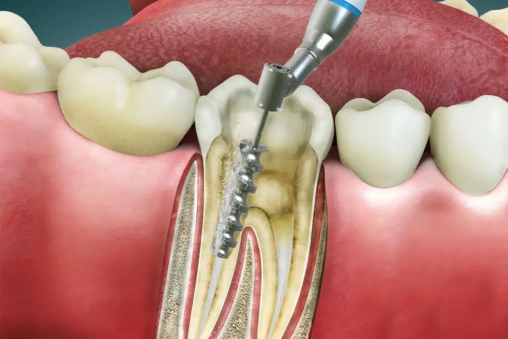 Root Canal Treatment Clinic in Cuttack