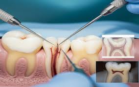 Root Canal Treatment in Cuttack