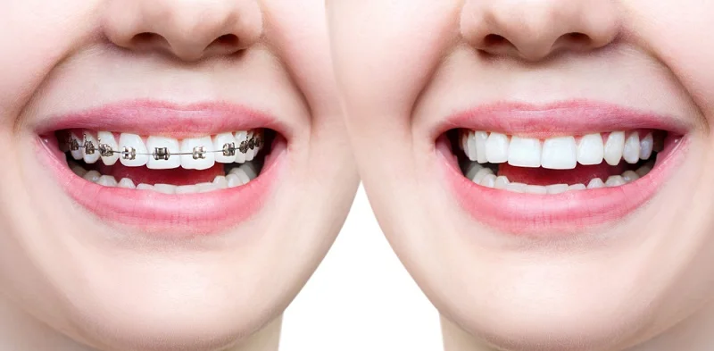 Dental Braces Before After.webp